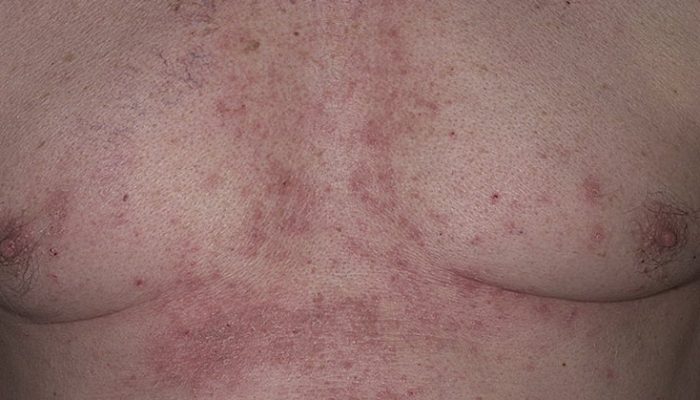 Почему возникают красные пятна на груди? Диагностика по клиническим проявлениям